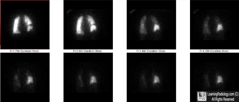 Swyer James Syndrome